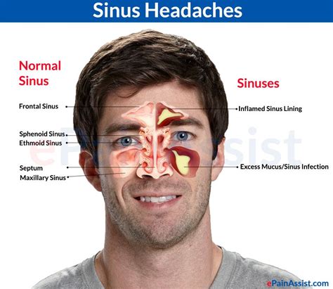 sinus infection dizzy